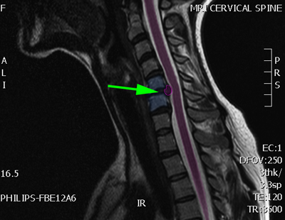 CervicalHernia2