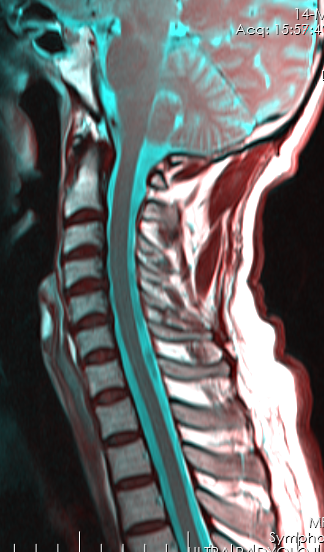 CervicalSpine2