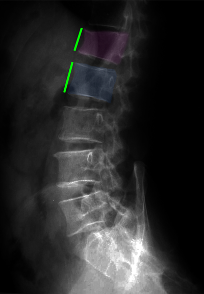 Spondyloplasty2