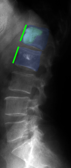 Spondyloplasty3